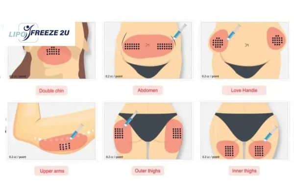 Benefits of Choosing Aqualyx for Fat Reduction Thrapston