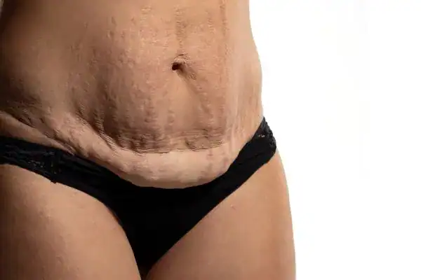 loose skin after weight loss injections Thrapston