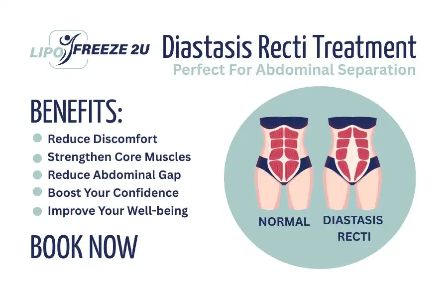 Benefits of body toning treatment Thrapston for Diastasis recti