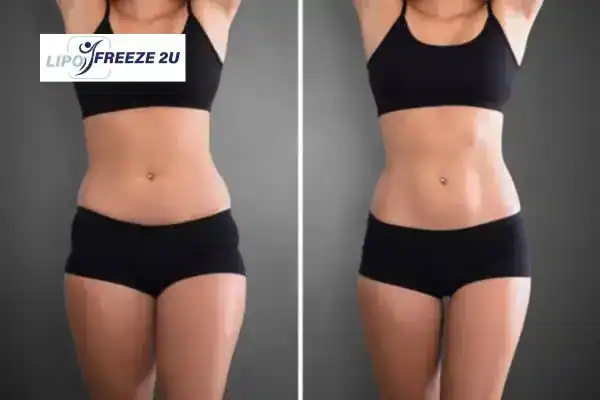 How Can LIPO FREEZE 2U Support Your Post-Pregnancy Body Recovery Thrapston?