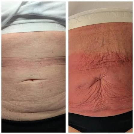 How Does RF Microneedling Improve Crepey, Thin and Uneven Skin Texture Thrapston?