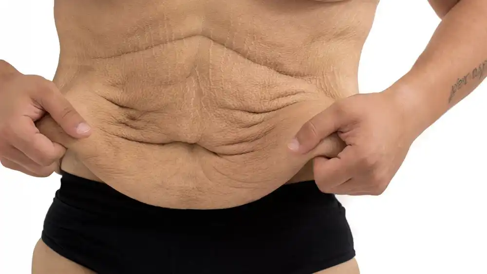 RF Microneedling for Loose Skin: How Can It Help Tighten and Reshape the Skin Thrapston?